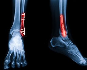 Traumatic Injuries & Fractures