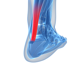 Tendonitis & Tendinopathy